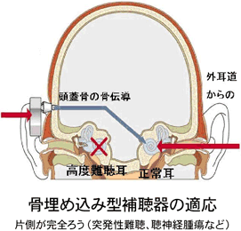 埋込型補聴器のイメージ図