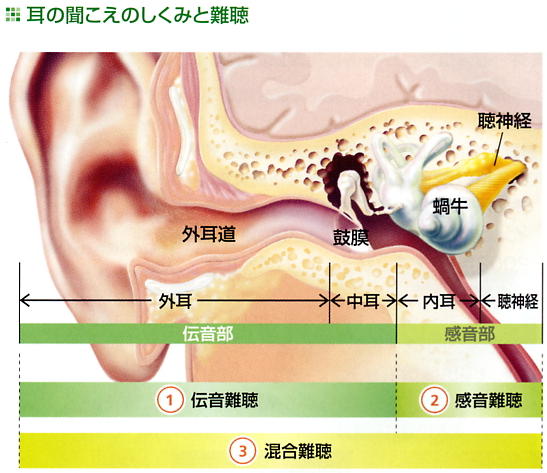 耳の聞こえのしくみと難聴の説明図